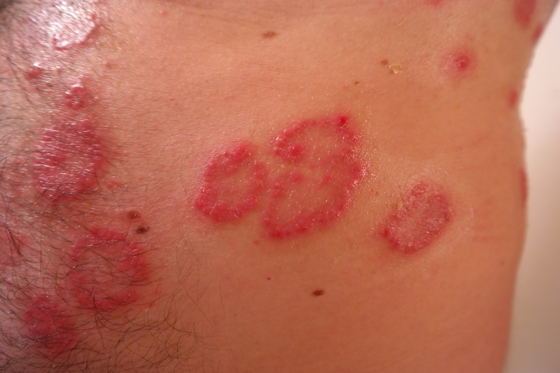 How To Treat Psoriasis DrugsBank