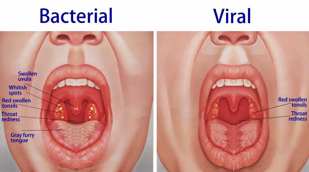 What To Do When Sore Throat Doesn t Heal DrugsBank