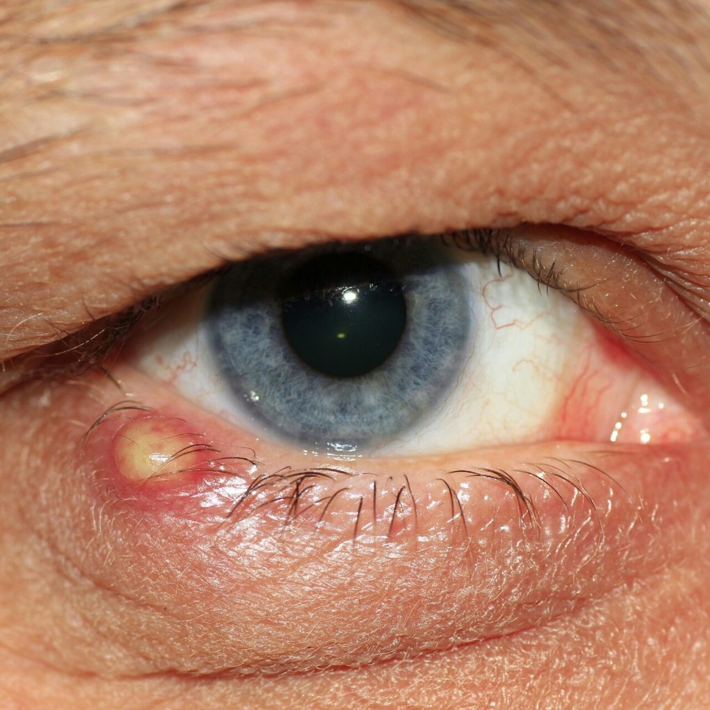 How To Treat A Stye Naturally Medically DrugsBank