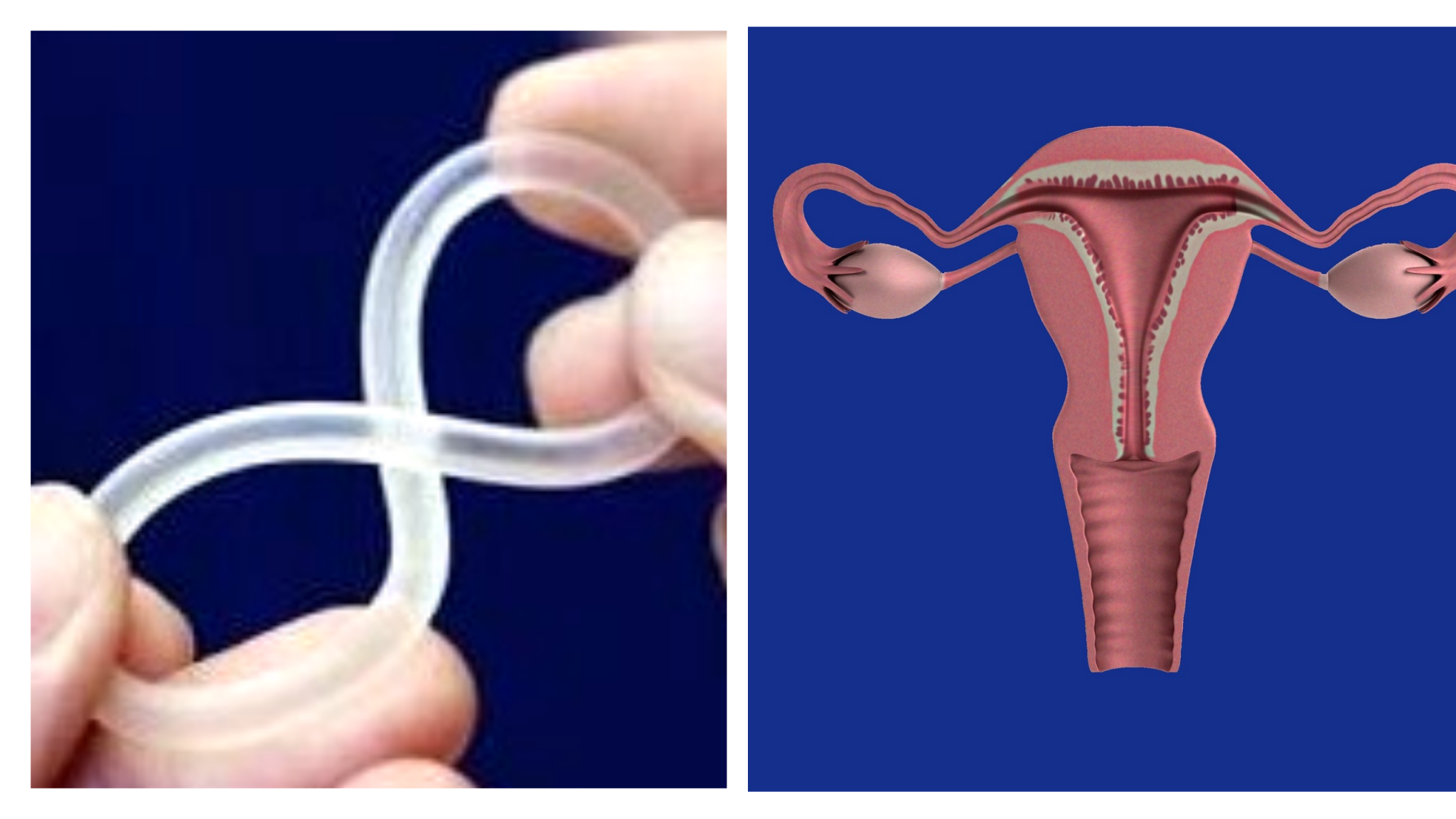 Fda Approves A New Viginal Ring Contraceptive Annovera That Can Be Used For A Year Drugsbank